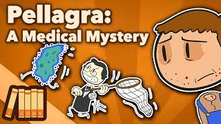 Pellagra  A Medical Mystery  Extra History [upl. by Patsis]