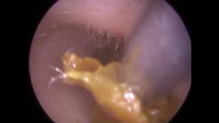 262  Fully occluding and impacted Oily Ear Wax Removal by Ear Microsuction [upl. by Cibis]