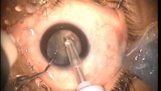 PHACO IN WHITE CATARACT WITH AKREOS AO LENS IMPL [upl. by Vasya]