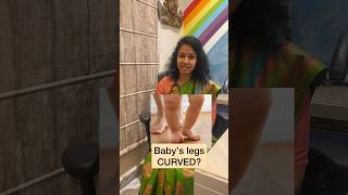 Bow legs in babies youtubeshortsyoutubepediatricsdoctorbabyparentingbabycaretipseducation [upl. by Lucky]