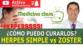 HERPES SIMPLE ⚔️ HERPES ZOSTER ¿CÓMO SE CURAN TRATAMIENTO HERPES Medicina Clara [upl. by Ahsonek]