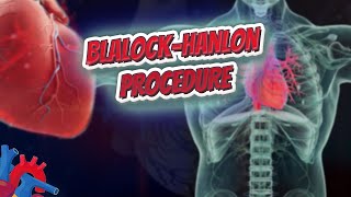 Blalock–Hanlon procedure Human Heart ❤️ amp Cardiology ❤️🔊✅ Human Heart ❤️ amp Cardiology ❤️🔊✅ [upl. by Lrad773]