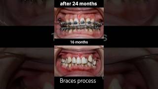 braces process after 24 months braces transformation braces orthodontist dentist shorts viral [upl. by Alvy]