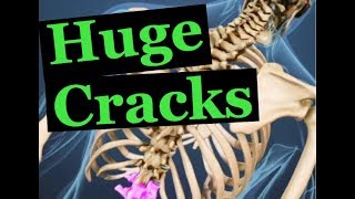 AWESOME Full Spine Chiropractic Adjustment with Huge Cracks [upl. by Nylzzaj]