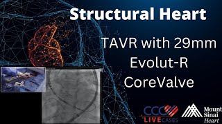 TAVR with 29mm EvolutR CoreValve  Structural Heart Sept 2017 [upl. by Enileve]