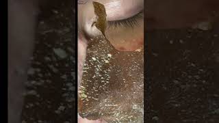 How to Clean up ACNE Fast on Your Beautiful Face  Remove ACNE FAST With Our Treatment Secrets [upl. by Dione157]