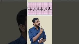 Supraventricular tachycardia ytshorts ecg fmge usmle plab mbbs [upl. by Anitnemelc]