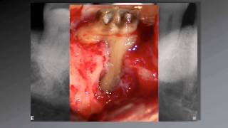 036 El uso de aumento en Endodoncia [upl. by Nunes]