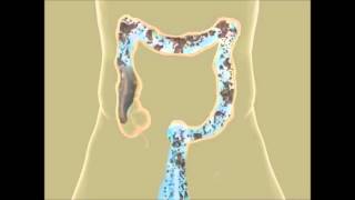 Colon Hydrotherapy in Pune  Constipation Treatment  Piles Treatment  Detox  Colon Cleansing IBS [upl. by Porta]