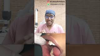 Dr Rudra Mohan  oralpigmentation whitepatches oralcancerawareness drrudrasdentalcare dental [upl. by Mcroberts]