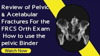 Review of Pelvic amp Acetabular Fractures For the FRCS Orth Exam  How to use the pelvic Binder [upl. by Kalin]