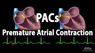 Premature Atrial Contractions PACs Animation [upl. by Malliw]