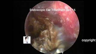 Ear wax removalReview collection of cholesteatomas of the external auditory canal，12mins [upl. by Almund]