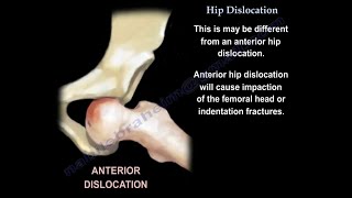 Hip Dislocation what is hip dislocation and how do we deal with it  how urgent it is [upl. by Atinet]