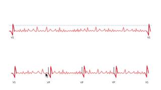 Pacemaker Issues Explained Part 3 Navigating Oversensing [upl. by Schwitzer945]