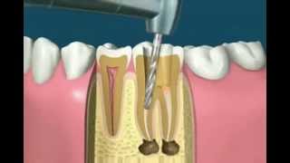Traitement radiculaire [upl. by Eedyaj]