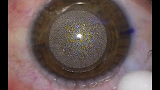 Actual SMILE eye laser vision correction procedure [upl. by Lenard]