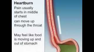 What Are the Symptoms of GERD [upl. by Calendra187]