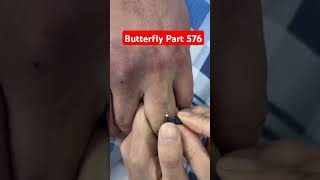 Butterfly  Part 576  Medical shorts scalping youtubeshorts viralvideo butterflyshorts doctor [upl. by Phail]