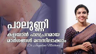 warts  Treatment and removal  പാലുണ്ണി  ഫലപ്രദമായ ചികിത്സ  Dr Jaquline Mathews BAMS [upl. by Reich]