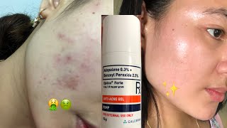 EPIDUO FORTE  14days Mabilis nakaalis ng PIMPLES ko acnetreatment skincare acne [upl. by Prescott]