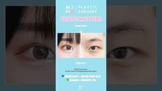 Blepharoplasty mihoplasticsurgerykorea4827 [upl. by Atnad]