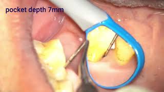 remobing dental calculus with micro retraction technique [upl. by Radbun]