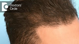 Do Finasteride have any side effects  Dr K Prapanna Arya [upl. by Karr]