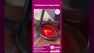 Deep Scar Removal Treatment  Laser Treatment For Deep Scars  Dr Vimalas Skin Hair amp Laser Centre [upl. by Aihpos]