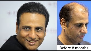 Hair Transplant Clinic in Mumbai at Eugenix Hair Sciences India [upl. by Maressa]