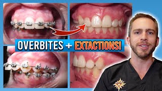 Braces Overbite Treatment BEFORE amp AFTER [upl. by Clova]