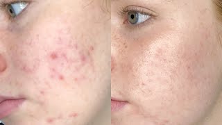 Spironolactone  Acne Review [upl. by Silver239]