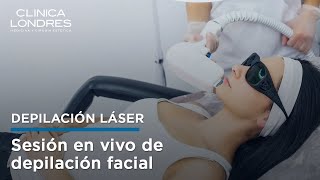 Depilación láser facial sesión con paciente real [upl. by Merna786]