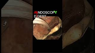 Almost Complete Dehiscence GastroJejunal Anastomosis in RYGB shorts [upl. by Auqinimod]