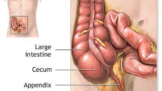 What side is your appendix on Symptoms Conditions and Treatments [upl. by Atsed]