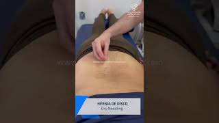 Dry Needling e Laserterapia no tratamento de hérnia de disco [upl. by Joseito]