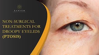 NonSurgical Treatments For Droopy Eyelids Ptosis  Radium Medical Aesthetics [upl. by Eilrebmik]