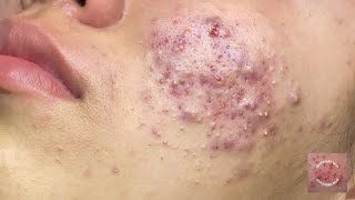 Inflammatory acne is a type of skin acne that often comes with swelling redness and pus [upl. by Annaul]