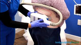 CoolSculpting Upper Flanks  Body Sculpting Regina  DEMO [upl. by Verity]