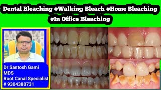 Dental Bleaching Bleachig Vital Bleaching Home Bleaching In Office Bleaching [upl. by Clover54]