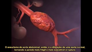 Saiba tudo sobre Aneurisma de Aorta Abdominal AAA  Dr Vinicius Lain [upl. by Emanuela879]