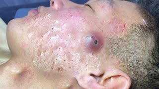 Big Cystic Acne Blackheads Extraction Blackheads amp Milia Whiteheads Removal Pimple Popping  409 [upl. by Bower]