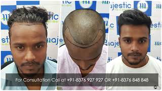 Receding Hairline  Most Natural Hairline Design amp Hair Transplant Results [upl. by Goldin]