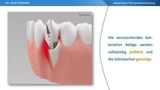 Ablauf der Behandlung  Parodontalbehandlung [upl. by Poler609]