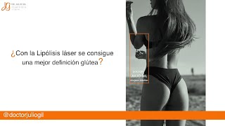 Lipolaser vs liposuccion Diferencias Riesgos ¿ideal para modelos Testimonio [upl. by Elyrrad]