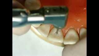 Palatal pit cavity preparation for amalgam  GV Black  Dr Ahmed Sleibi [upl. by Desmond367]