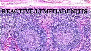 WHAT IS REACTIVE LYMPHADENITIS [upl. by Zebedee]