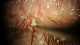 Demodex Blepharitis Plaque Removal with Forceps  Eyelash Mite at 539 [upl. by Israel]