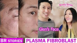 What is Plasma Fibroblast Skin Tightening Treatment in detail [upl. by Onairam330]