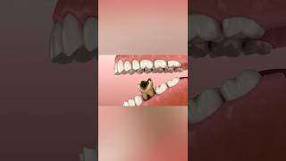 Losing molar tooth 3D animation dentist health [upl. by Nesyaj797]